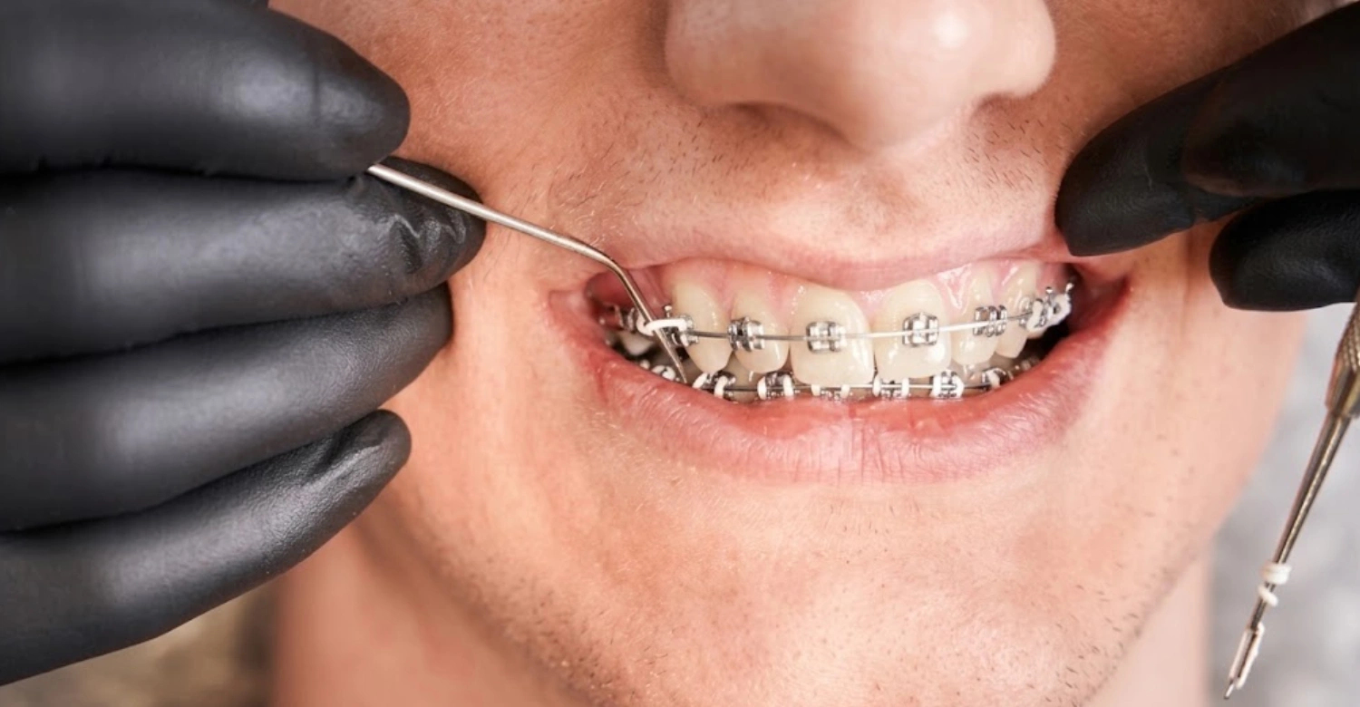Can Braces Fix TMJ Inblog